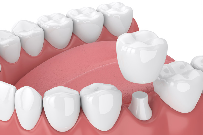 Dental Crowns in Upper Marlboro