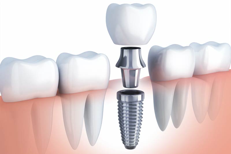 Implants Dentist in Upper Marlboro